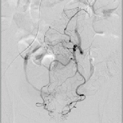 Distal selective inferior mesenteric artery catheter angiogram shows an... | Download Scientific ...