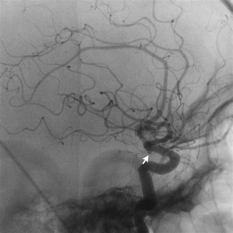 The Radiology Assistant Non Traumatic Intracranial Hemorrhage