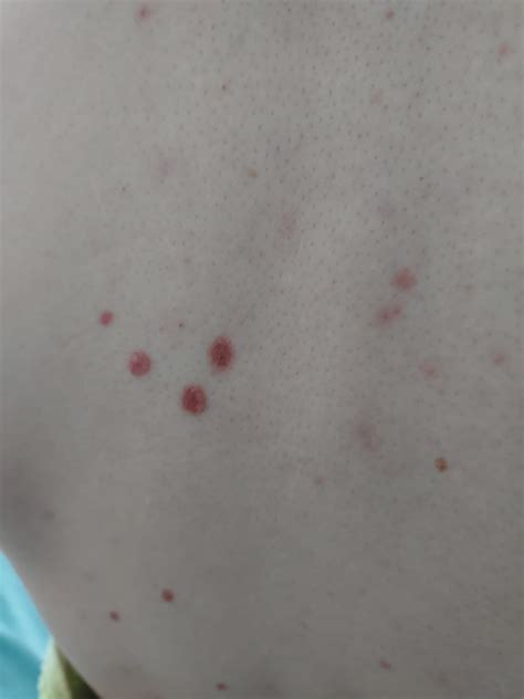 Weird moles on back? : r/Melanoma