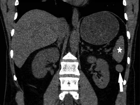 Coronal Ct Scan Of Accessory Spleen Below Spleen Level Accessory