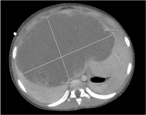 Axial View Of Pre Operative Ct Scan This Image Demonstrates That Download Scientific Diagram