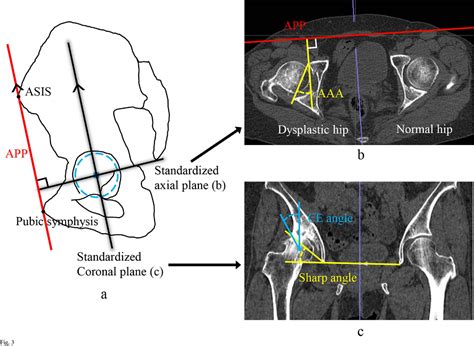 Hip Spine Syndrome Acetabular Anteversion Angle Is Associated With