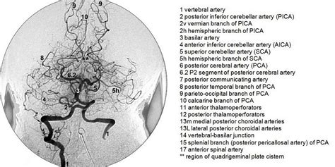 Dr Balaji Anvekar Frcr Normal Brain Angiogram Dsa