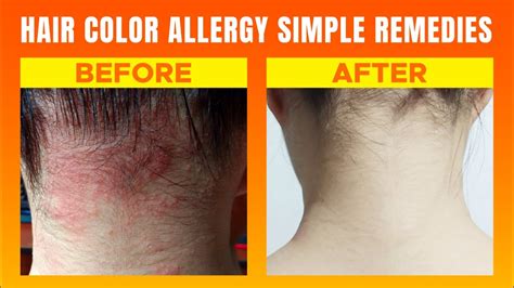 Hair Color Allergy Treatments Causes Symptoms Treatments And Prevention By Yellow Heart