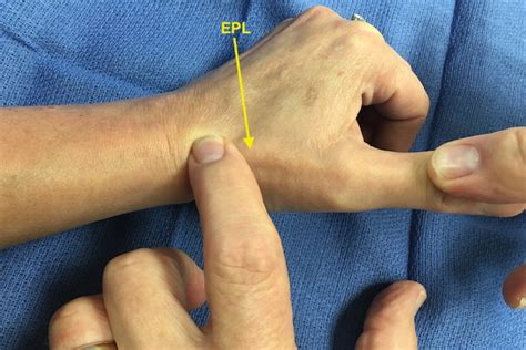 Extensor Tendon Exam Hand Surgery Resource