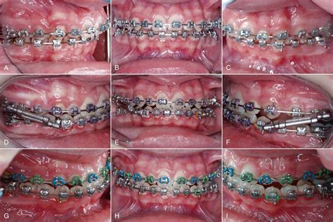 13 Class Ii Correction With An Intermaxillary Fixed Noncompliance Device Pocket Dentistry