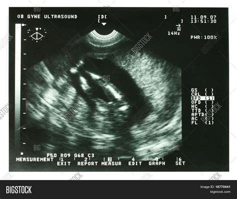 Ultrasound Image Three Image And Photo Free Trial Bigstock