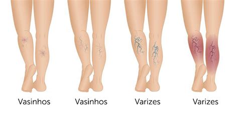 qual a diferenca entre varizes e vasinhos Pró Corpo Estética Avançada