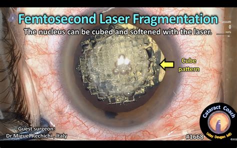 Femtosecond Laser Cataract Coach™