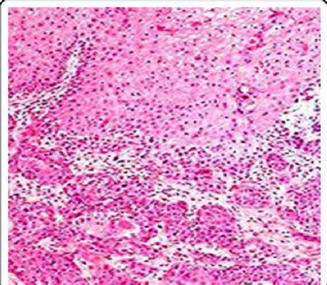 Squamous Cell Carcinoma Of Anal Canal Delineating Enlarged Squamous