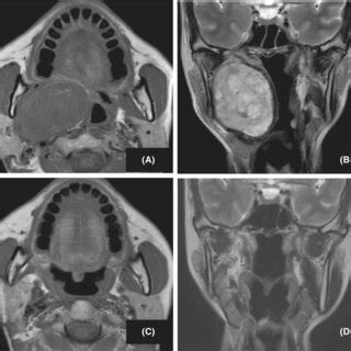 Mr Imaging Of Case A Preoperative T Weighted Horizontal Section