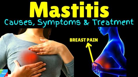 Mastitis Breast Infection Symptoms Causes Treatment Prevention