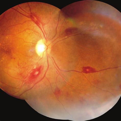 Right Eye Fundus Photograph Of Posterior Pole Showing Numerous Download Scientific Diagram