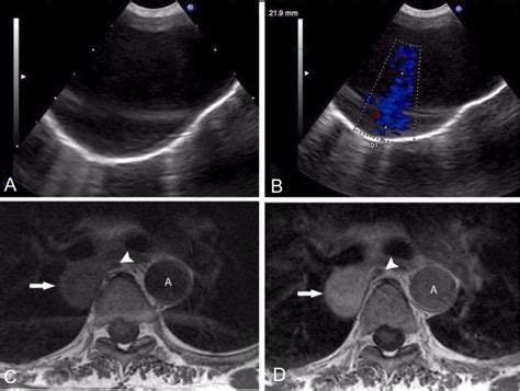 Rare Cause Of A Posterior Mediastinal Mass Diagnosed At Endobronchial Ultrasound Bmj Case Reports