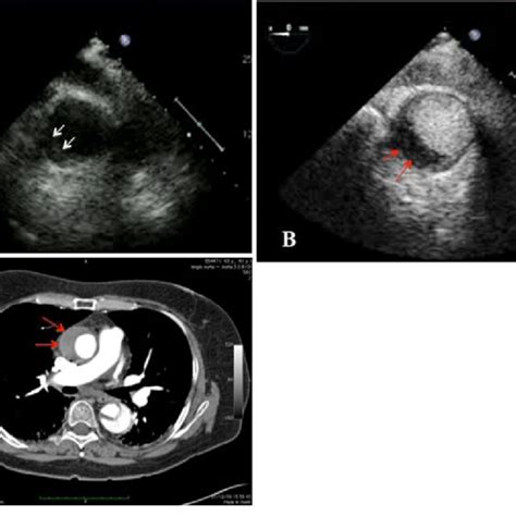 A Short Axis Standard Tee Imaging Of The Ascending Aorta A Crescent