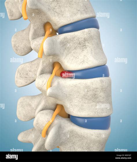 Human Lumbar Spine Model Demonstrating Herniated Disc Pressure Nerve