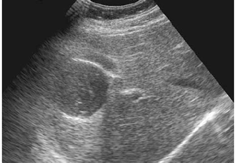 Photomicrograph Shows Laminated Membrane Long Arrows And Germinal