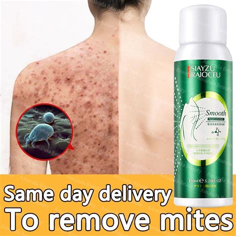 back acne treatment spray Antibacterial Anti Acne Gentle Exfoliating ...