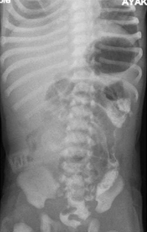 Unusual Neonatal Case Of Superior Mesenteric Artery Syndrome With