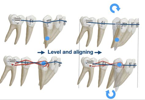 To Laceback Or Not To Laceback That Is The Question Orthodontics In