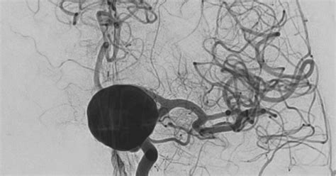 Tratamentos De Aneurismas Cerebrais Sem Cirurgia Aberta