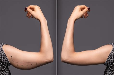 Premium Photo Woman Arms With Bat Wings Comparison Between Before And After Brachioplasty Surgery