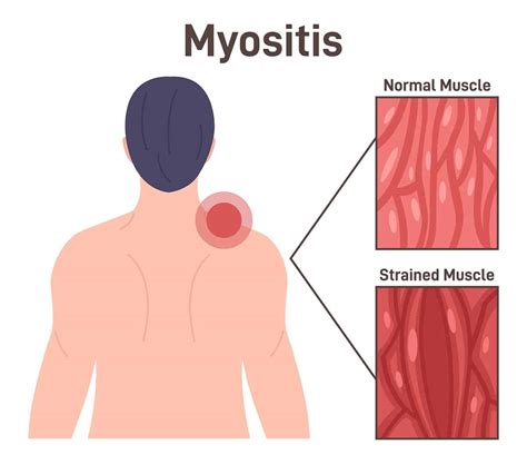 Myositis In Singapore Dr Annie Law Rheumatologist Singapore