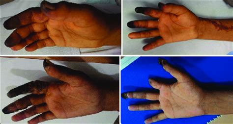 Partial Loss Of Digits In A Patient Following Right Radial Arterial