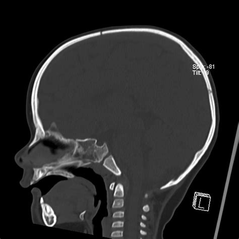 Spheno Occipital Synchondrosis Pacs