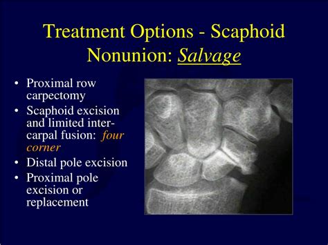 PPT Carpal Fractures And Dislocations PowerPoint Presentation Free