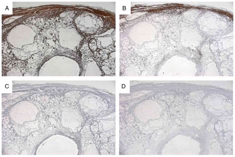 Primary Anastomosing Hemangioma As A Preoperative Diagnostic Mimicker