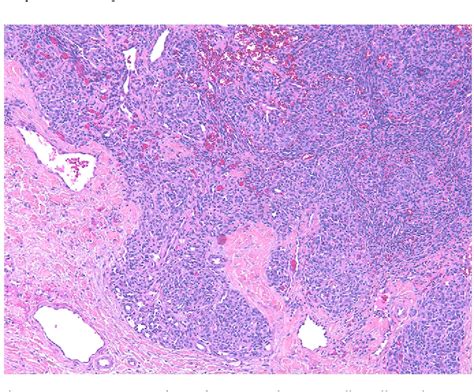 Table 1 From Kaposiform Hemangioendothelioma And Tufted Angioma Epi