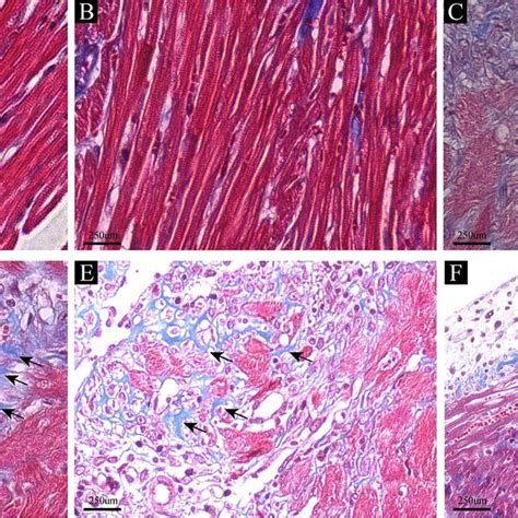 Icariin Inhibited Myocardial Fibrosis Masson Trichrome Staining