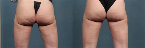 Cellulite Treatments Before After Photos Patient 264 Louisville