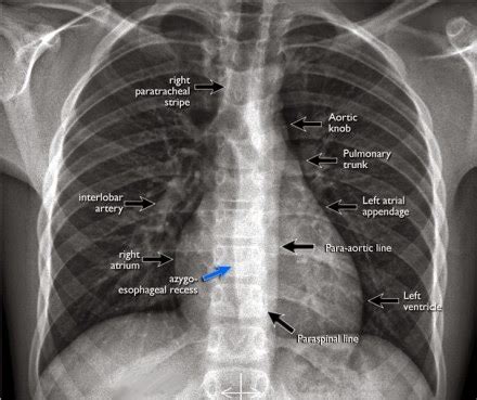 Chest Medicine Made Easy Dr Deepu Chest X Ray The Diaphragm Is Unique