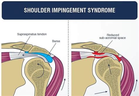 Rotator Cuff Tear Vs Impingement How To Tell The Difference Mma Life