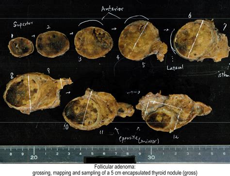 Pathology Outlines Follicular Adenoma