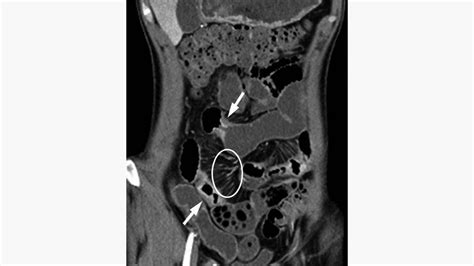 Crohn’s Disease Radiology: CT, MRI, Ultrasound, and More