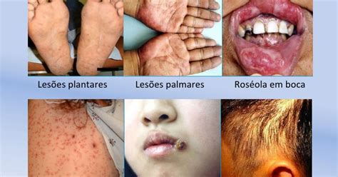 Enfermedades infecciosas CAUSAS Y FACTORES DE RIESGO DE LA SÍFILIS