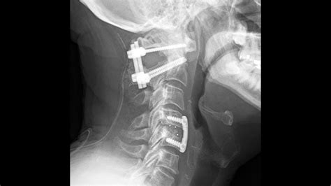 Posterior Occipital C1 And C2 Fusion Part 1 Occipital Neck Surgery