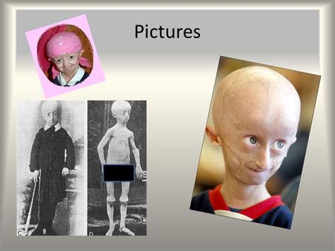 Progeria By Sean Burns And Zachary Scott Your Basic Info Progeria Is