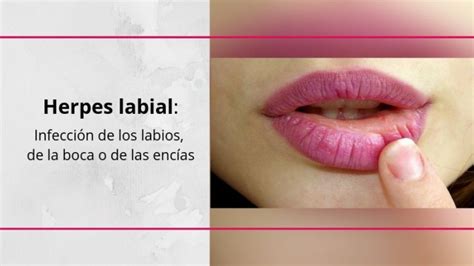 Hacer Un Nombre Apelar A Ser Atractivo Oculto Fases De Un Herpes Labial