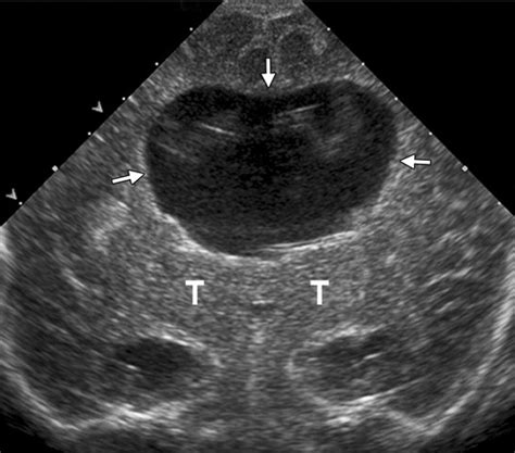 Porencephalic Cyst Ultrasound