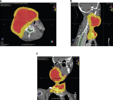 The Map Of The Patients Radiotherapy Target Volume A Transverse