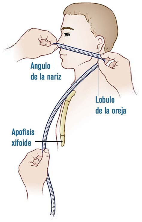 ATENSALUD Enfermaría Geriátrica y Sociosanitaria Colocación de Sonda