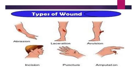 Types of wounds and management.