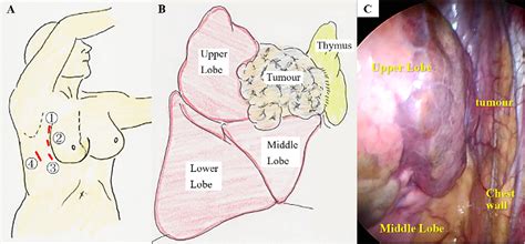 Figure 3 From Mediastinal Mature Teratoma Perforating The Right Lung