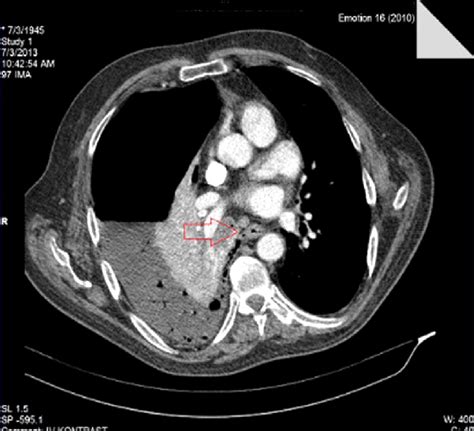 Ct Scan Of Esophageal Rupture Download Scientific Diagram