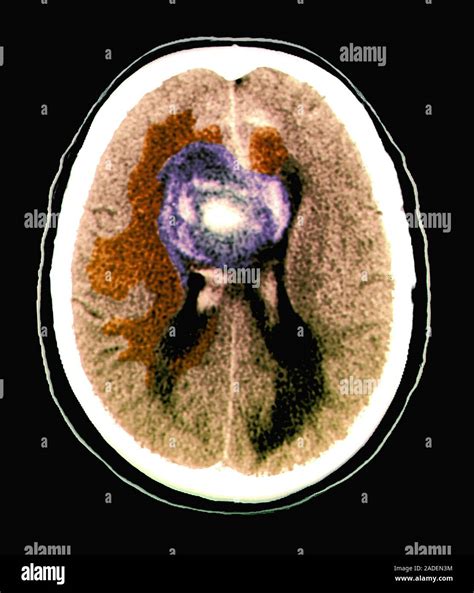 Glioblastoma tumor canceroso en el cerebro Un color de tomografía