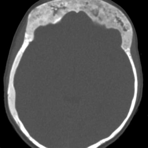 Coronal CT image in the same child as Figure 2. Both foramen rotundum ...